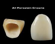 All Porcelain Crowns